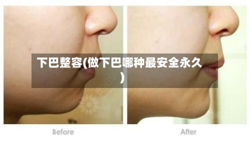 下巴整容(做下巴哪种最安全永久)-第3张图片